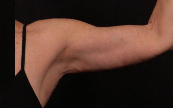 After Image: Brachioplasty (Arm Lift) - front