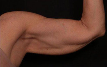 Before Image: Brachioplasty (Arm Lift) - front