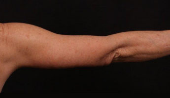 After Image: Brachioplasty (Arm Lift) - back