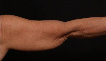 Before Image: Brachioplasty (Arm Lift) - back
