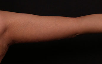 After Image: Brachioplasty (Arm Lift) - front