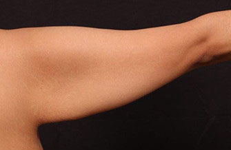 Before Image: Brachioplasty (Arm Lift) - front