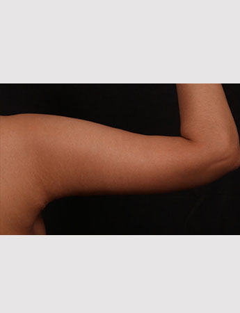 After Image: Brachioplasty (Arm Lift) - back