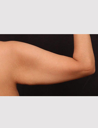 Before Image: Brachioplasty (Arm Lift) - back