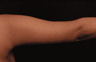 After Image: Brachioplasty (Arm Lift) - front
