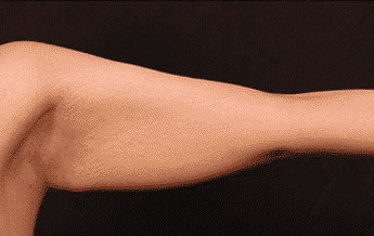 Before Image: Brachioplasty (Arm Lift) - front