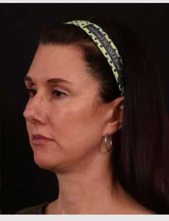 After Image: Neck Lift / Lower Facelift - left-front-oblique