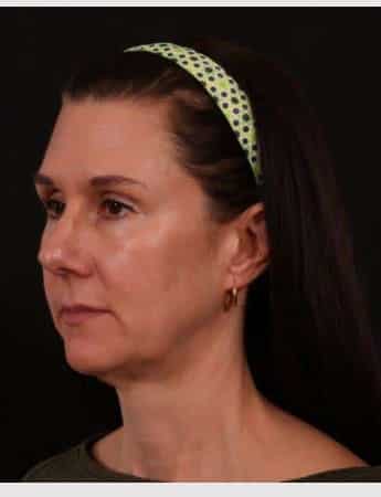 Before Image: Neck Lift / Lower Facelift - left-front-oblique