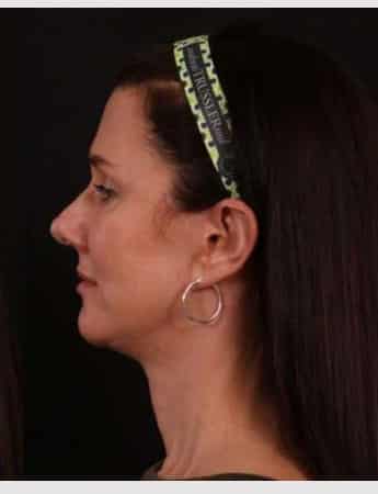 After Image: Neck Lift / Lower Facelift - left-side