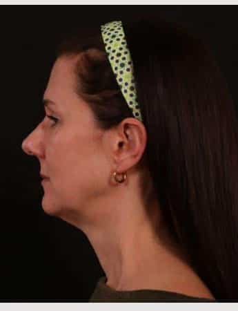 Before Image: Neck Lift / Lower Facelift - left-side