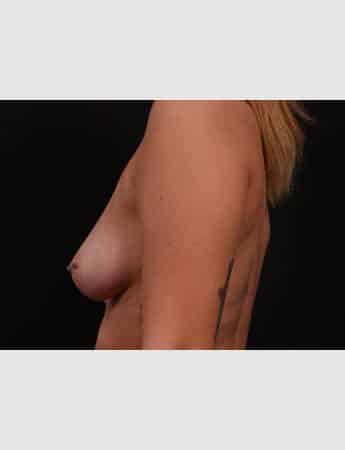 Before Image: Breast Augmentation - left-side