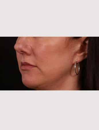 After Image: Lip Lift - left-front-oblique