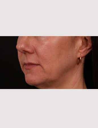 Before Image: Lip Lift - left-front-oblique
