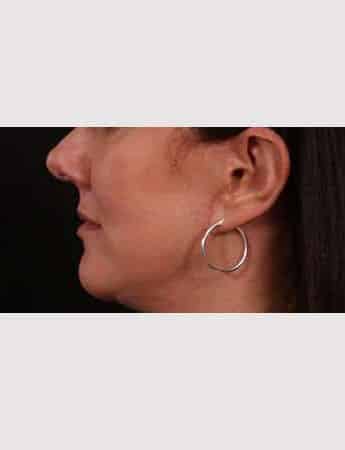 After Image: Lip Lift - left-side