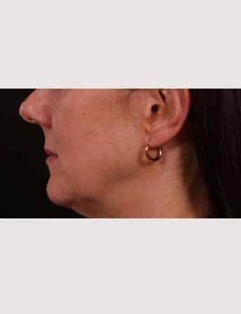 Before Image: Lip Lift - left-side
