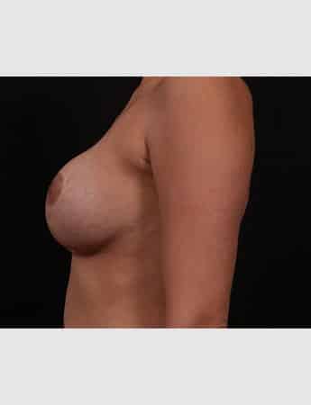 After Image: Secondary Breast Surgery - left-side