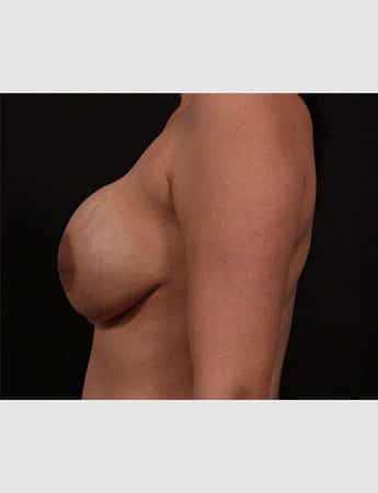 Before Image: Secondary Breast Surgery - left-side