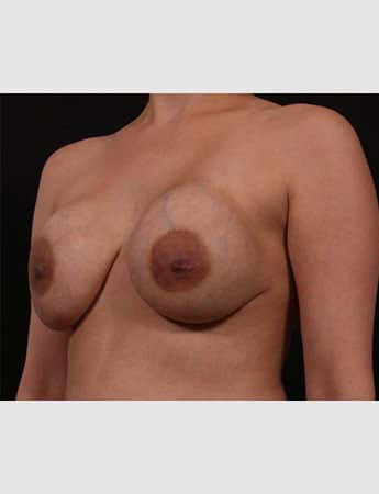 Before Image: Secondary Breast Surgery - left-front-oblique