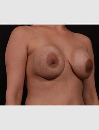 Before Image: Secondary Breast Surgery - right-front-oblique