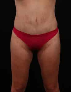 After Image: Inner Thigh Lift, Body Lift and Tummy Tuck