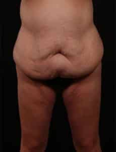 Before Image: Inner Thigh Lift, Body Lift and Tummy Tuck