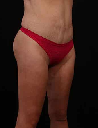 After Image: Inner Thigh Lift, Body Lift and Tummy Tuck - right-front-oblique