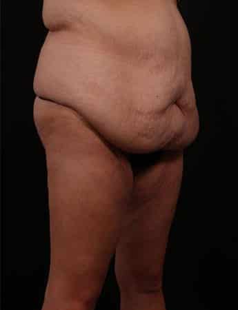 Before Image: Inner Thigh Lift, Body Lift and Tummy Tuck - right-front-oblique