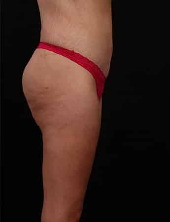After Image: Inner Thigh Lift, Body Lift and Tummy Tuck - right-side