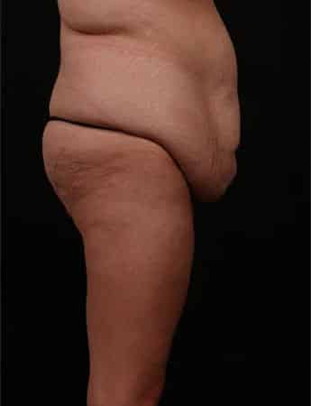 Before Image: Inner Thigh Lift, Body Lift and Tummy Tuck - right-side