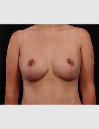 After Image: Mastopexy (Breast Lift) - front