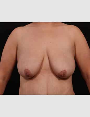 Before Image: Mastopexy (Breast Lift) - front