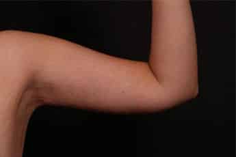 After Image: Brachioplasty (Arm Lift) - front