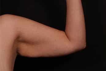 Before Image: Brachioplasty (Arm Lift) - front