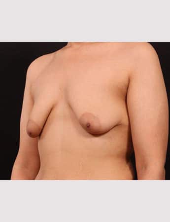 Before Image: Mastopexy with Augmentation - left-front-oblique
