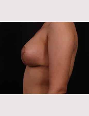 After Image: Mastopexy with Augmentation - left-side