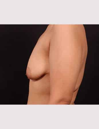 Before Image: Mastopexy with Augmentation - left-side