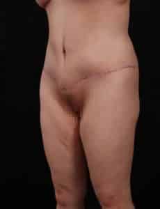 After Image: Body Lift
