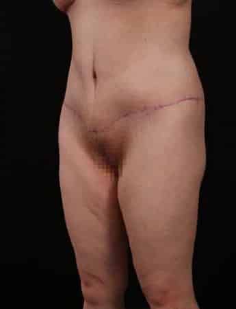 After Image: Body Lift - left-front-oblique