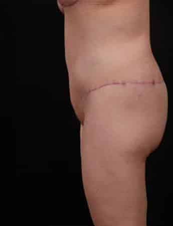 After Image: Body Lift - left-side