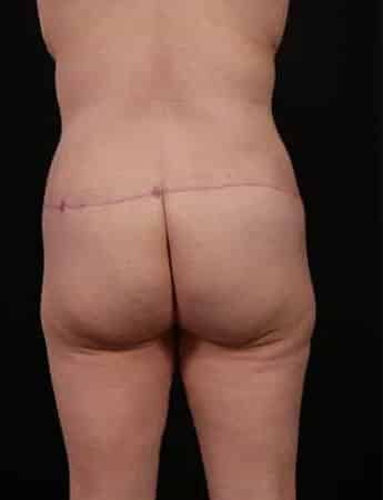 After Image: Tummy Tuck (Abdominoplasty) - back
