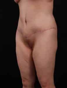 After Image: Outer Thigh Lift