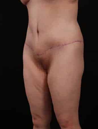 After Image: Outer Thigh Lift - left-front-oblique