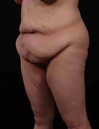 Before Image: Outer Thigh Lift - left-front-oblique
