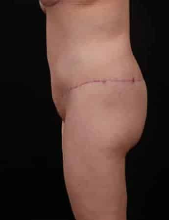 After Image: Outer Thigh Lift - left-side