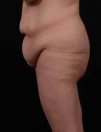 Before Image: Outer Thigh Lift - left-side