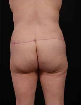 After Image: Outer Thigh Lift - back