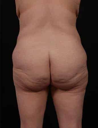 Before Image: Outer Thigh Lift - back