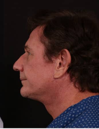 After Image: Neck Lift - left-side