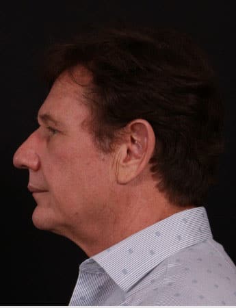 Before Image: Neck Lift - left-side