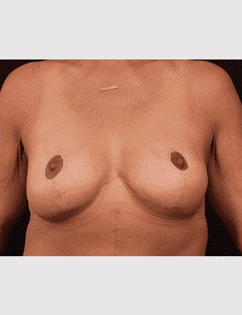 After Image: Mastopexy (Breast Lift) - front